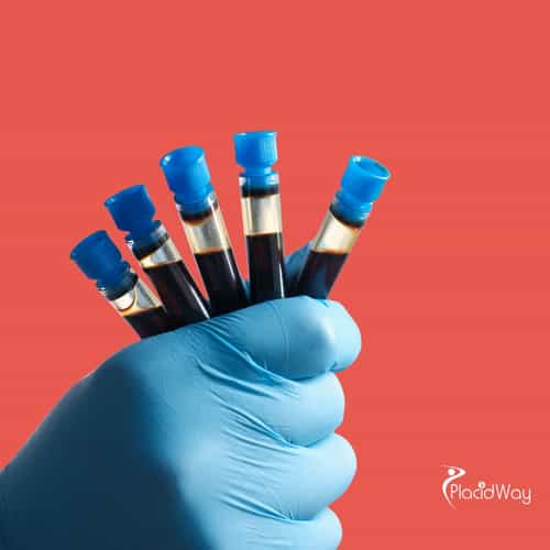 Restoring Strength and Wellness: Why Nigerian Patients Choose the UAE for PRP Stem Cell Therapy